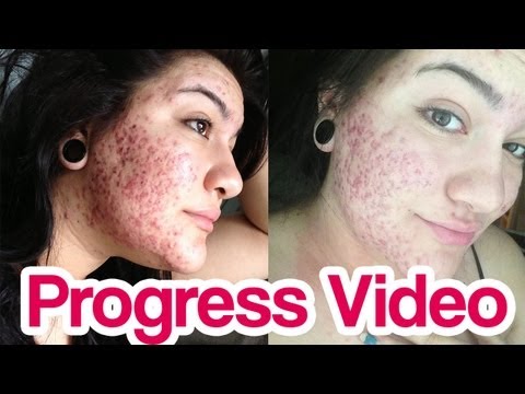 cost of accutane canada
