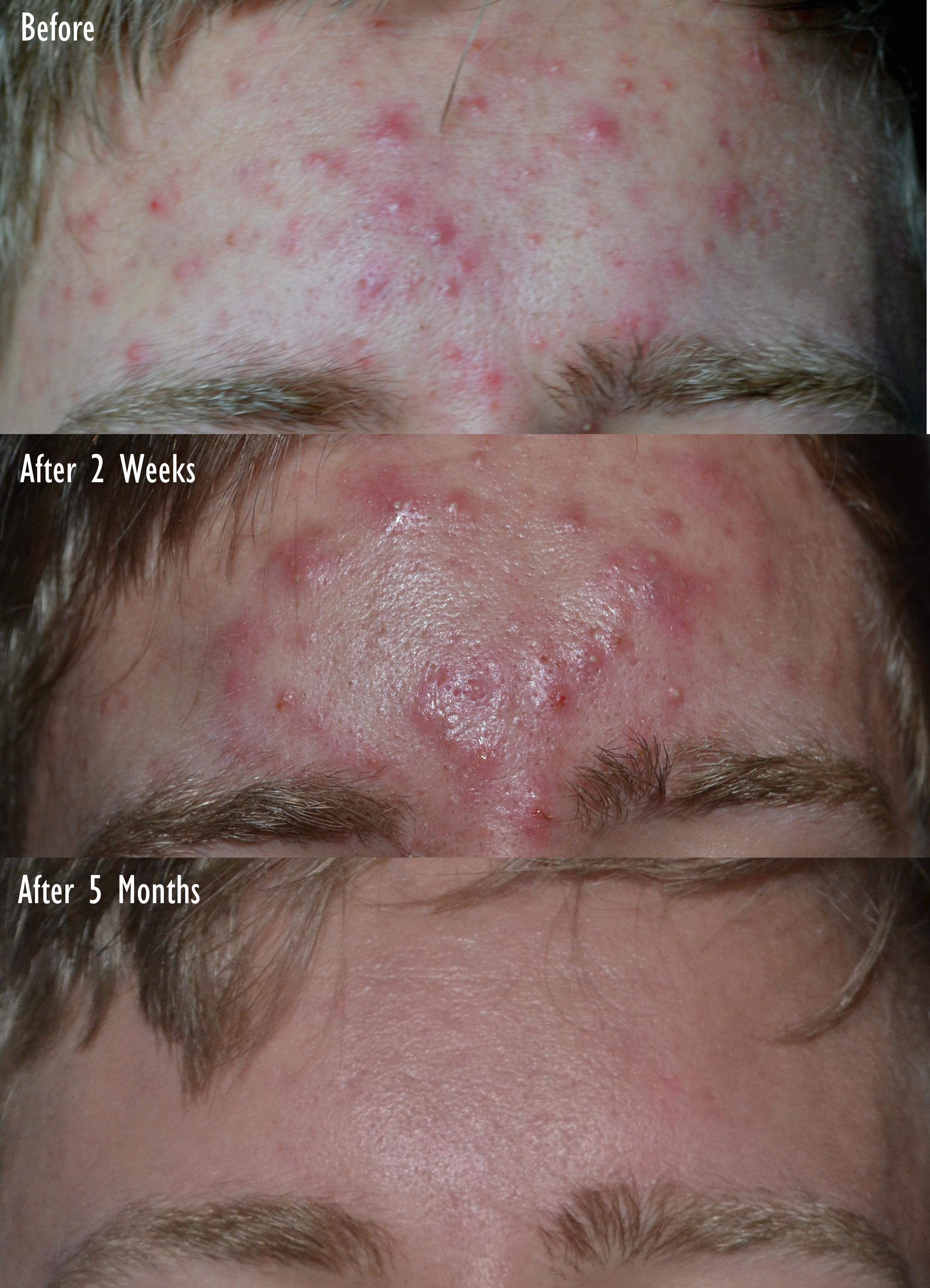 Cost for accutane