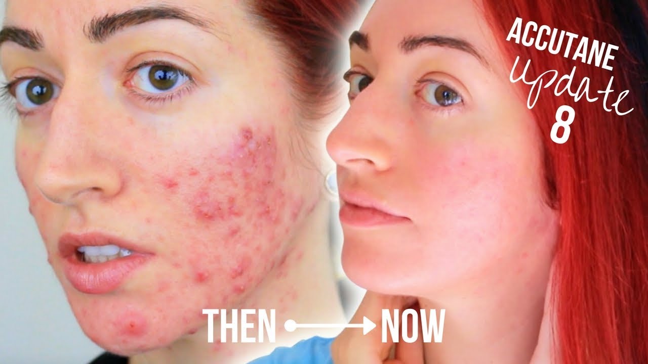 Accutane cost at costco
