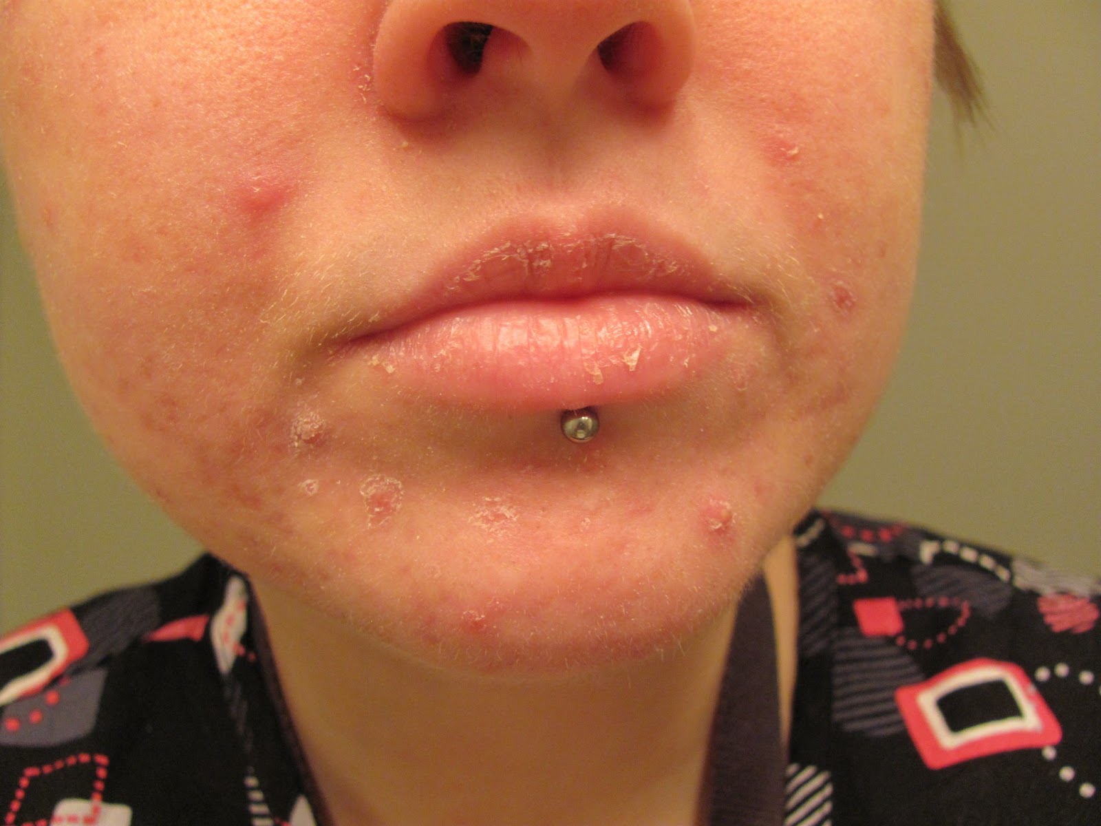 40mg Of Accutane